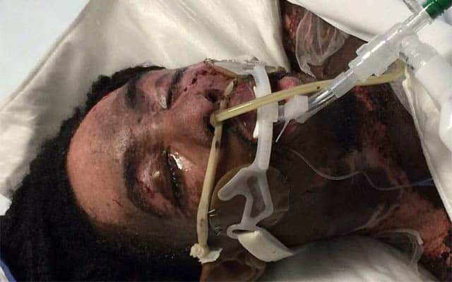 Burned Hate-Crime Victim’s GoFundMe Needs Your Support